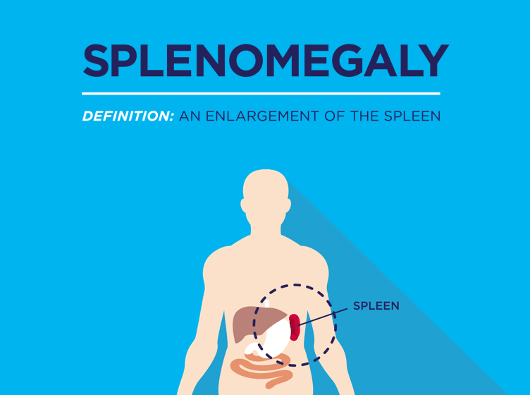 What Every Patient With an MPN Should Know About the Spleen