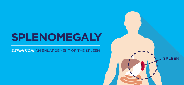 mpn-patient-know-about-spleen-Desktop-Tile